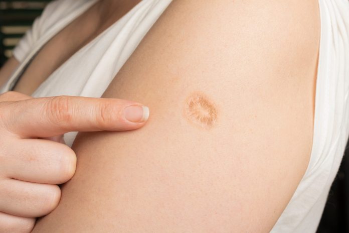Smallpox vaccine scars: What they look like and why