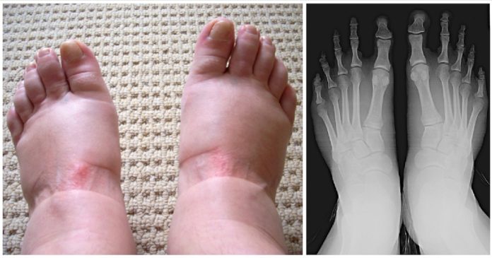 Swollen feet and hands: 10 alarming warning signs you should never ignore