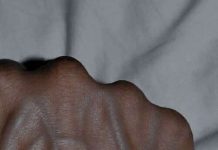 Visible Veins Explained: Normal Causes, Health Risks, and When to Worry