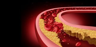 10 Subtle Symptoms of Clogged Arteries You Shouldn’t Ignore