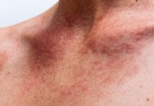 18 Signs of Histamine Intolerance