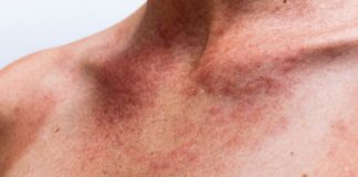 18 Signs of Histamine Intolerance