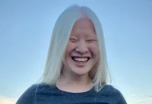 Girl abandoned at birth for her looks wants to prove the world wrong – she now models for Vogue