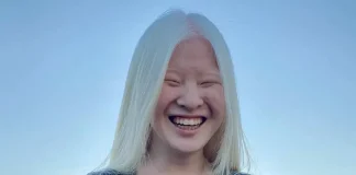 Girl abandoned at birth for her looks wants to prove the world wrong – she now models for Vogue