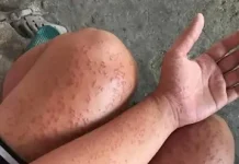 I spent a couple of nights at my friend’s previous apartment and saw these unusual bumps