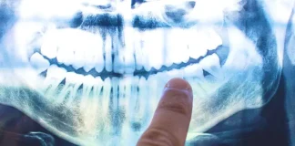 The cause of Alzheimer’s may lie within your mouth