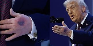 Trump explains the heavy bruise on his left hand came from ‘clipped it on the table’