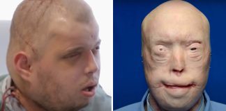 Firefighter suffers third-degree burns – this is him 7 years later