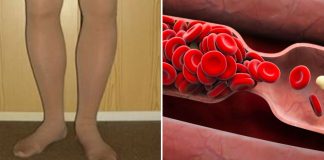 Your body warns you before a blood clot: 8 hidden signs you should never ignore
