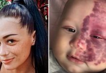 Mum labeled “monster” for lasering port-wine stain birthmark on her baby’s face