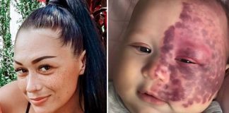 Mum labeled “monster” for lasering port-wine stain birthmark on her baby’s face