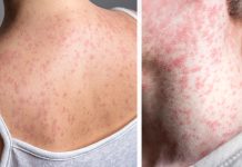 Measles symptoms explained as cases surge across U.S