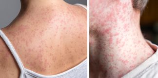 Measles symptoms explained as cases surge across U.S