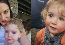 Toddler’s eye ”melts away” after wrong person kissed him