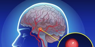 12 early warning signs of an aneurysm you shouldn’t ignore