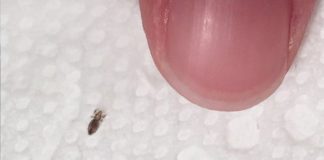 Head lice: How to get rid of them and stop them coming back